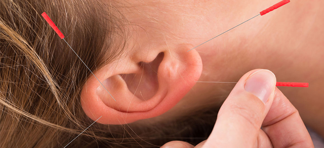 auricular-acupuncture-CT